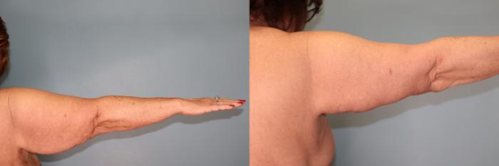 Before & After Brachioplasty or Arm Lift  Case 27 Back Side- Right  View in Oklahoma City, Tulsa, Norman, OK