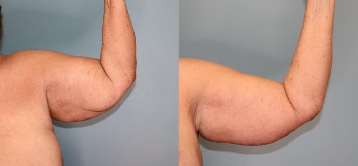 Before & After Brachioplasty or Arm Lift  Case 27 Front Side- Left Flexing  View in Oklahoma City, Tulsa, Norman, OK