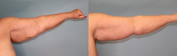 Before & After Brachioplasty or Arm Lift  Case 27 Front Side- Left View in Oklahoma City, Tulsa, Norman, OK