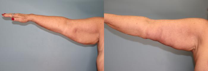 Before & After Brachioplasty or Arm Lift  Case 27 Front Side- Right  View in Oklahoma City, Tulsa, Norman, OK