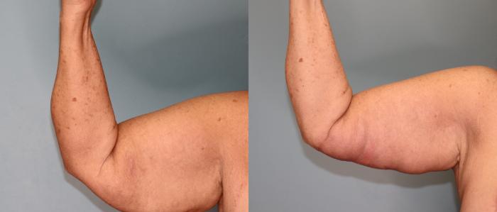 Before & After Brachioplasty or Arm Lift  Case 27 Front Side- Right Flexing  View in Oklahoma City, Tulsa, Norman, OK