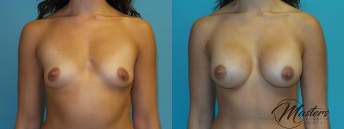 Before & After Breast Augmentation Case 1 Front View in Oklahoma City, Tulsa, Norman, OK