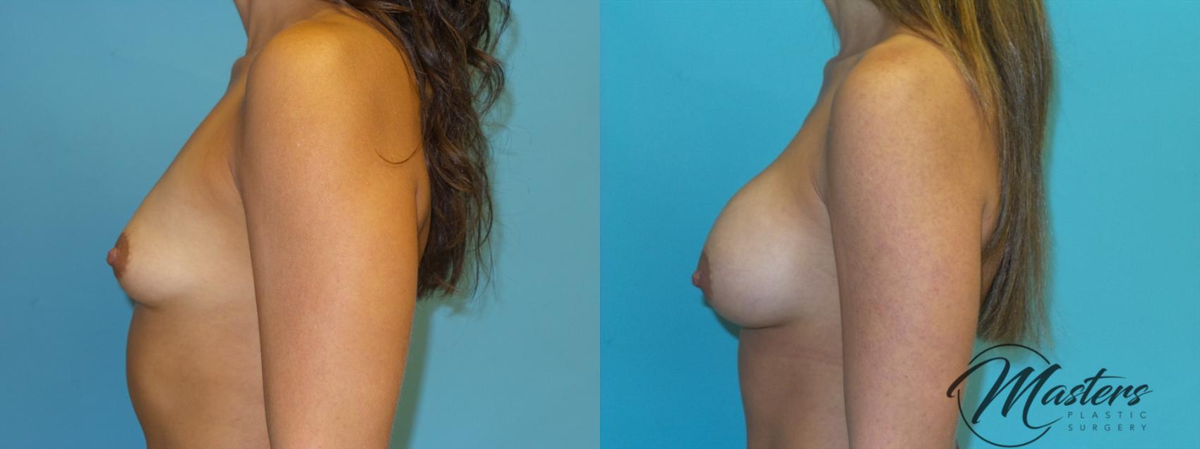 Before & After Breast Augmentation Case 1 Left Side View in Oklahoma City, Tulsa, Norman, OK