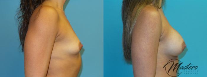 Before & After Breast Augmentation Case 1 Right Side View in Oklahoma City, Tulsa, Norman, OK