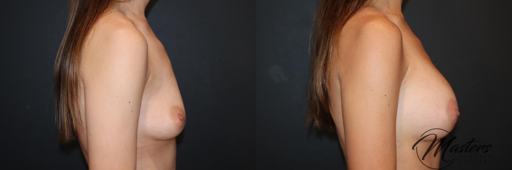 Breast Augmentation