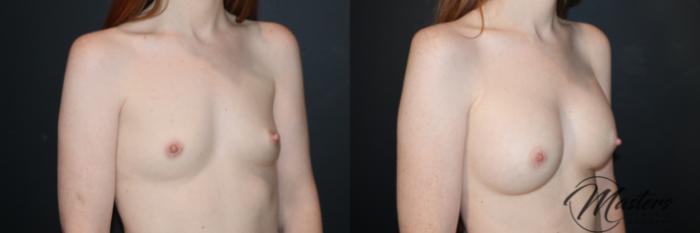 Before & After Breast Augmentation Case 119 Right Oblique View in Oklahoma City, Tulsa, Norman, OK