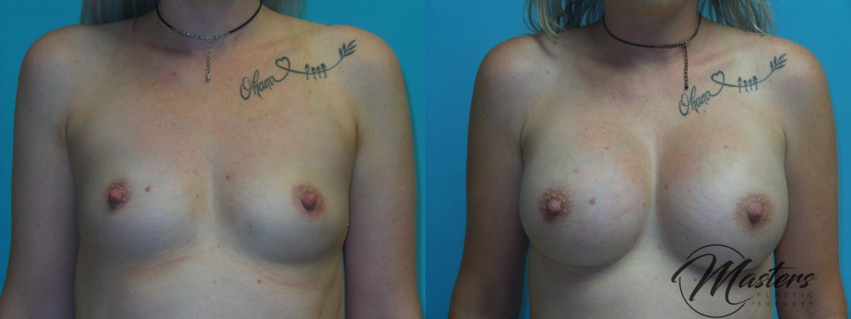 Before & After Breast Augmentation Case 2 Front View in Oklahoma City, Tulsa, Norman, OK