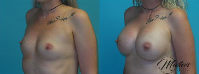 Before & After Breast Augmentation Case 2 Left Oblique View in Oklahoma City, Tulsa, Norman, OK