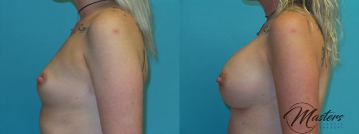 Before & After Breast Augmentation Case 2 Left Side View in Oklahoma City, Tulsa, Norman, OK