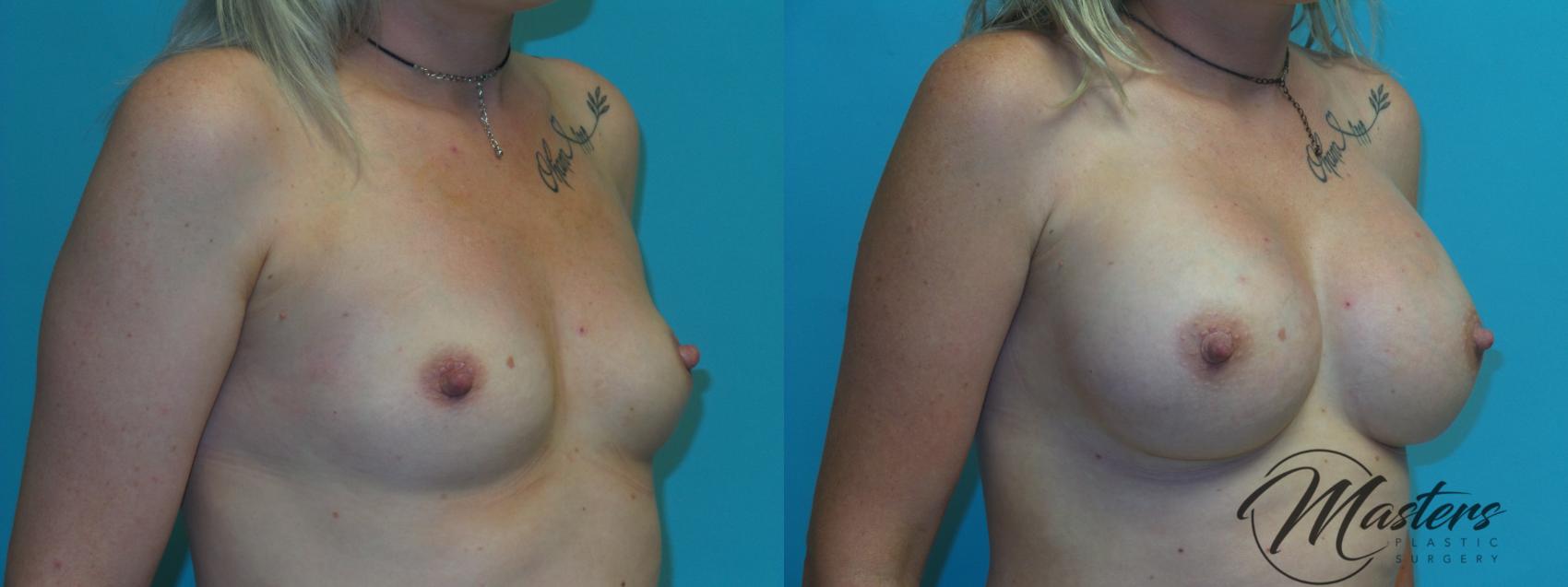 Before & After Breast Augmentation Case 2 Right Oblique View in Oklahoma City, Tulsa, Norman, OK