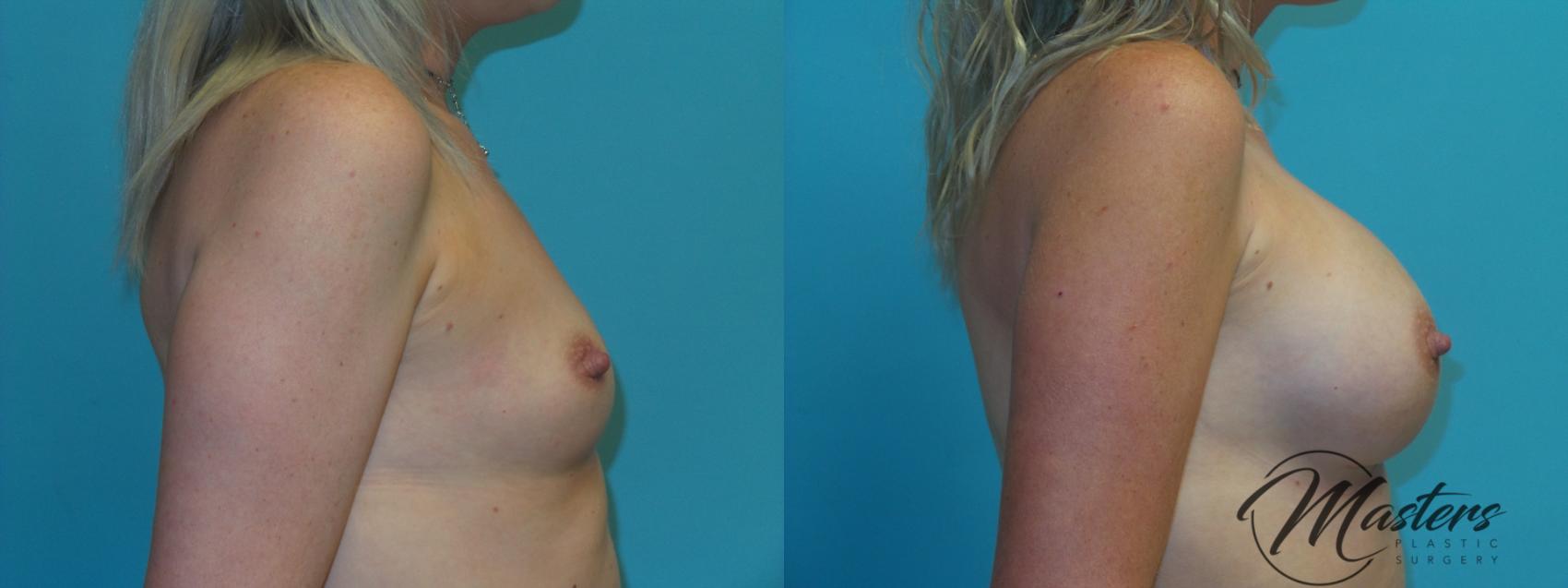 Before & After Breast Augmentation Case 2 Right Side View in Oklahoma City, Tulsa, Norman, OK