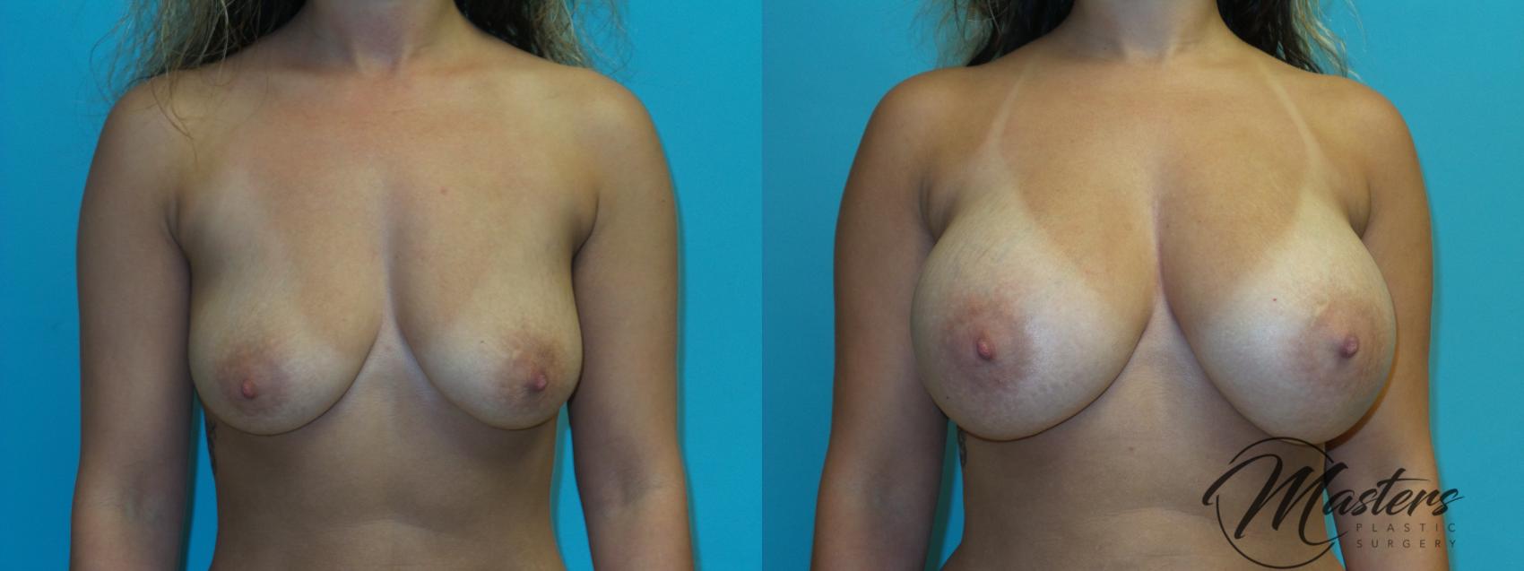 Before & After Breast Augmentation Case 20 Front View in Oklahoma City, Tulsa, Norman, OK