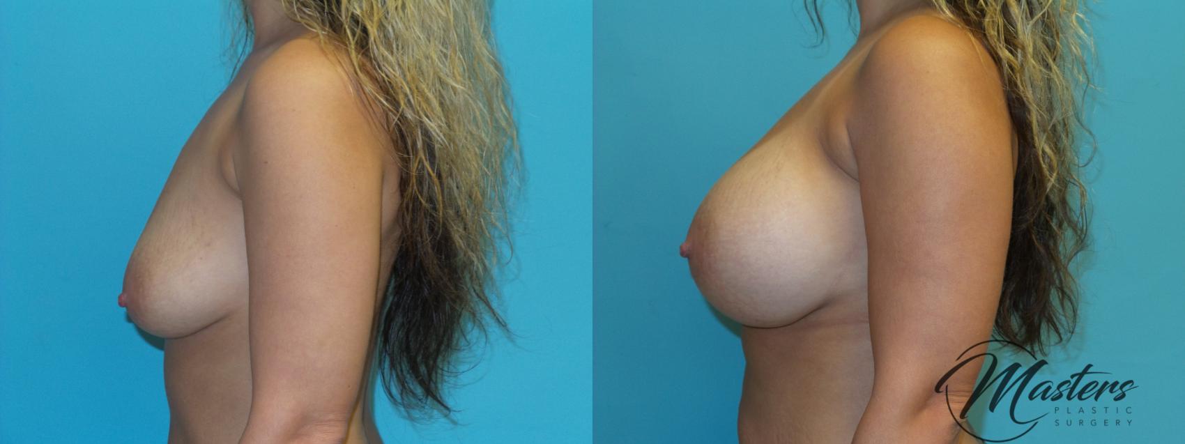 Before & After Breast Augmentation Case 20 Left Side View in Oklahoma City, Tulsa, Norman, OK