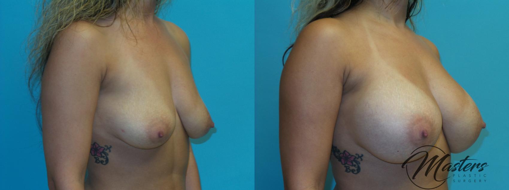 Before & After Breast Augmentation Case 20 Right Oblique View in Oklahoma City, Tulsa, Norman, OK