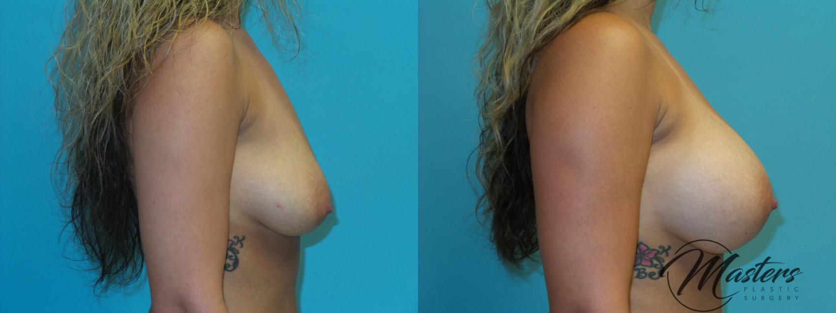 Before & After Breast Augmentation Case 20 Right Side View in Oklahoma City, Tulsa, Norman, OK