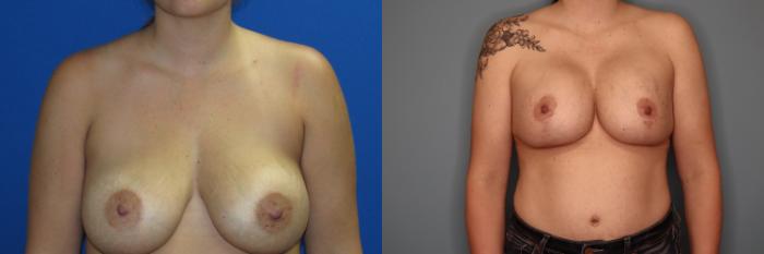 Before & After Breast Augmentation Case 28 Front View in Oklahoma City, Tulsa, Norman, OK