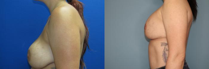 Before & After Breast Augmentation Case 28 Left Side View in Oklahoma City, Tulsa, Norman, OK