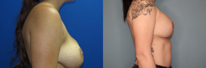 Before & After Breast Augmentation Case 28 Right Side View in Oklahoma City, Tulsa, Norman, OK