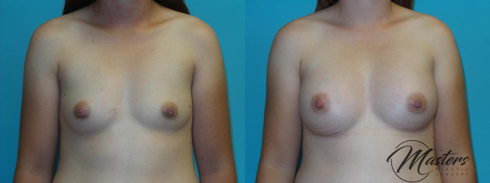 Before & After Breast Augmentation Case 3 Front View in Oklahoma City, Tulsa, Norman, OK