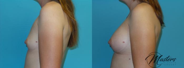 Before & After Breast Augmentation Case 3 Left Side View in Oklahoma City, Tulsa, Norman, OK