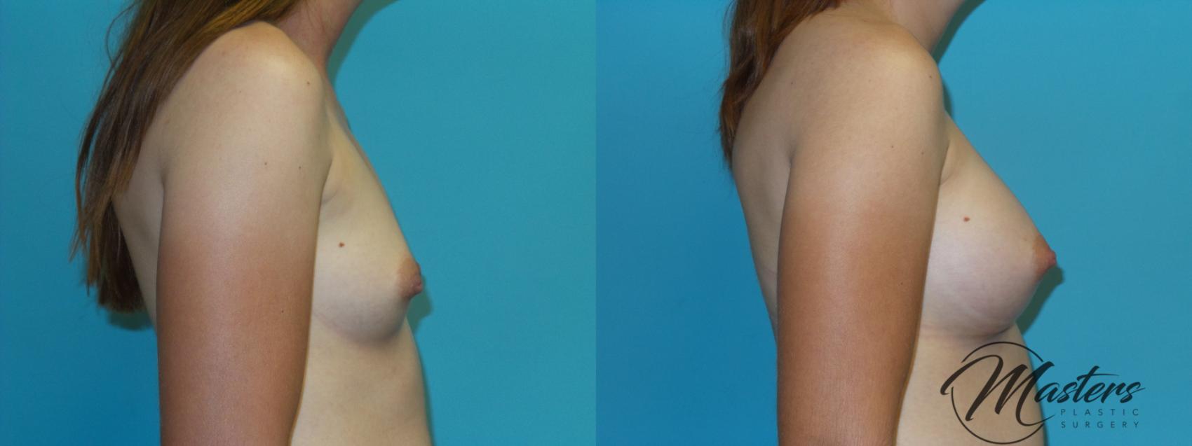 Before & After Breast Augmentation Case 3 Right Side View in Oklahoma City, Tulsa, Norman, OK