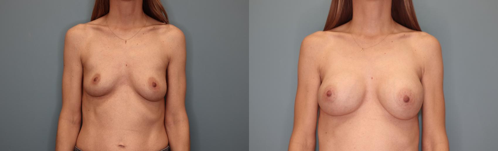 Before & After Breast Augmentation Case 30 Front View in Oklahoma City, Tulsa, Norman, OK