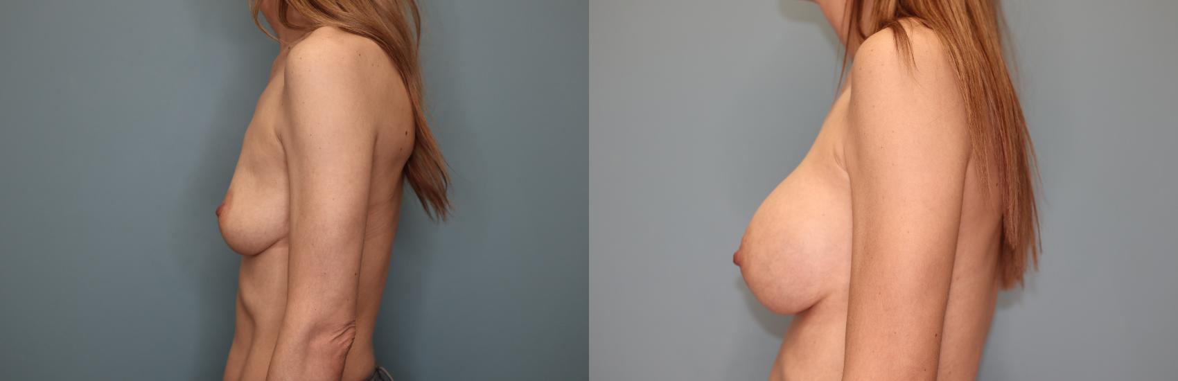 Before & After Breast Augmentation Case 30 Left Side View in Oklahoma City, Tulsa, Norman, OK