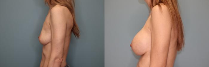 Before & After Breast Augmentation Case 30 Left Side View in Oklahoma City, Tulsa, Norman, OK