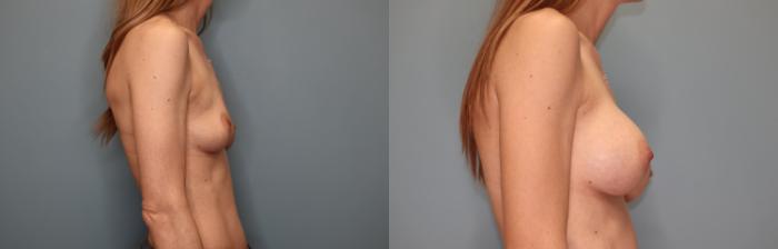 Before & After Breast Augmentation Case 30 Right Side View in Oklahoma City, Tulsa, Norman, OK