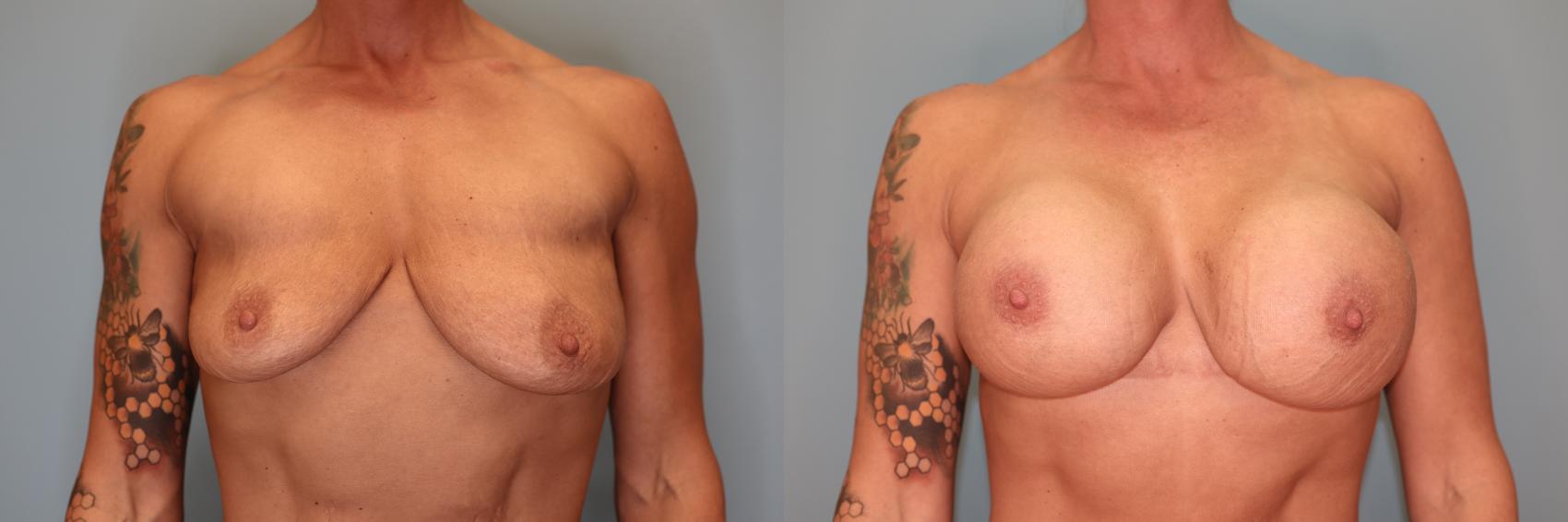 Before & After Breast Augmentation Case 31 Front View in Oklahoma City, Tulsa, Norman, OK