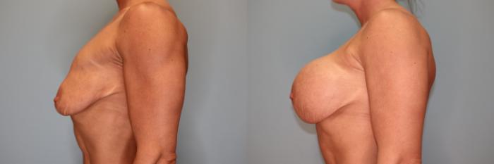 Before & After Breast Augmentation Case 31 Left Side View in Oklahoma City, Tulsa, Norman, OK