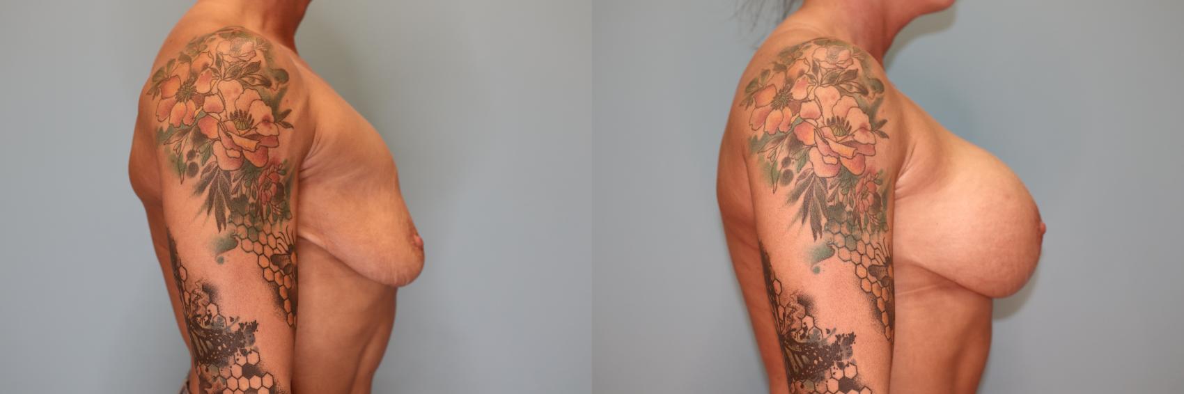 Before & After Breast Augmentation Case 31 Right Side View in Oklahoma City, Tulsa, Norman, OK