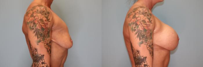 Before & After Breast Augmentation Case 31 Right Side View in Oklahoma City, Tulsa, Norman, OK