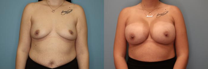 Before & After Breast Augmentation Case 34 Front View in Oklahoma City, Tulsa, Norman, OK