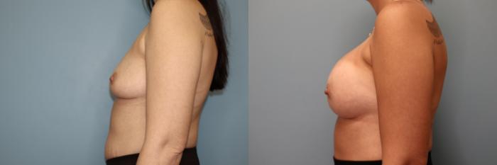 Before & After Breast Augmentation Case 34 Left Side View in Oklahoma City, Tulsa, Norman, OK