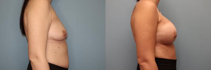 Before & After Breast Augmentation Case 34 Right Side View in Oklahoma City, Tulsa, Norman, OK