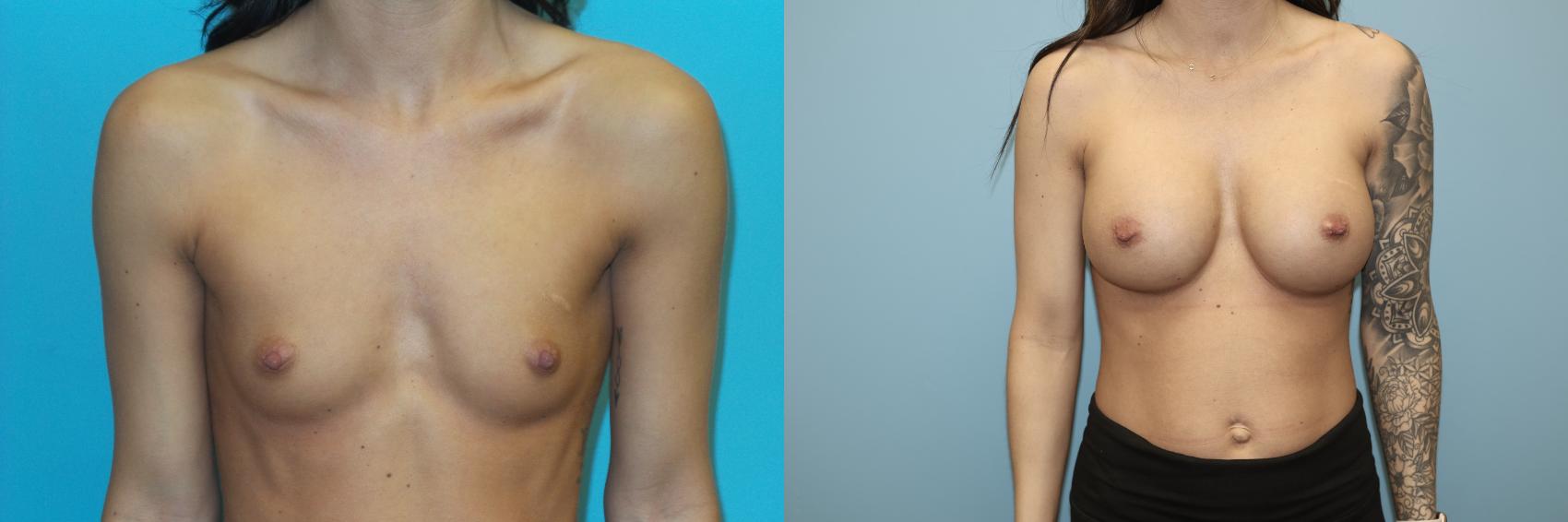 Before & After Breast Augmentation Case 35 Front View in Oklahoma City, Tulsa, Norman, OK
