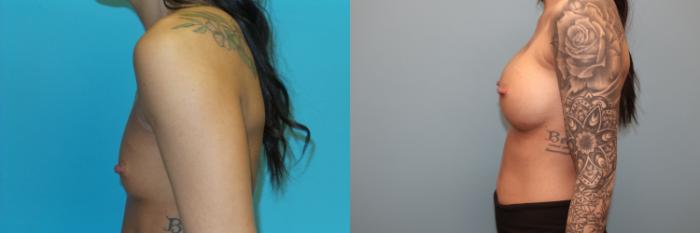 Before & After Breast Augmentation Case 35 Left Side View in Oklahoma City, Tulsa, Norman, OK