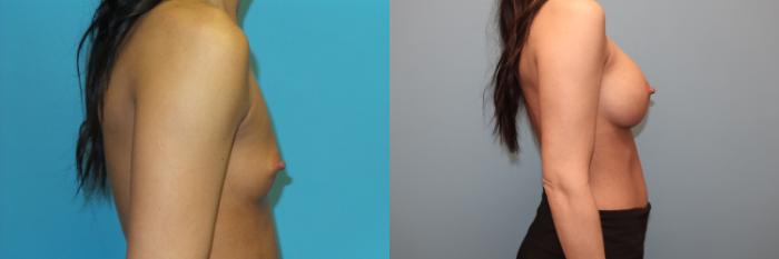 Before & After Breast Augmentation Case 35 Right Side View in Oklahoma City, Tulsa, Norman, OK