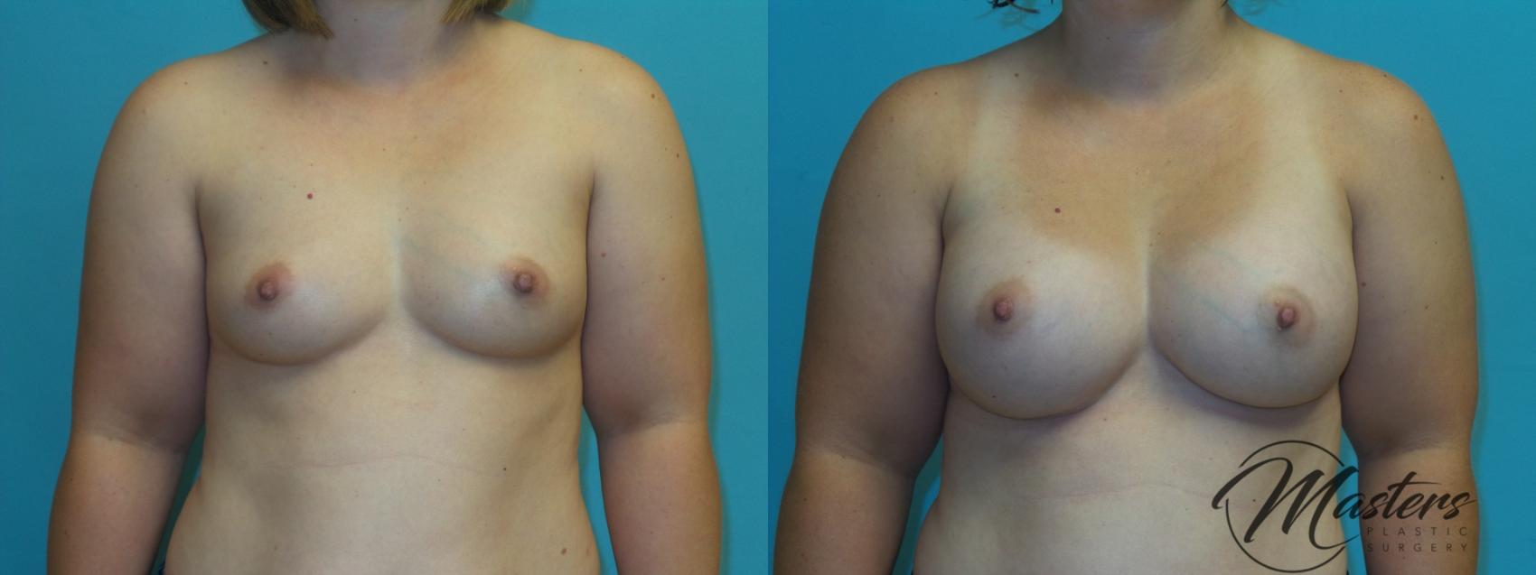 Before & After Breast Augmentation Case 4 Front View in Oklahoma City, Tulsa, Norman, OK