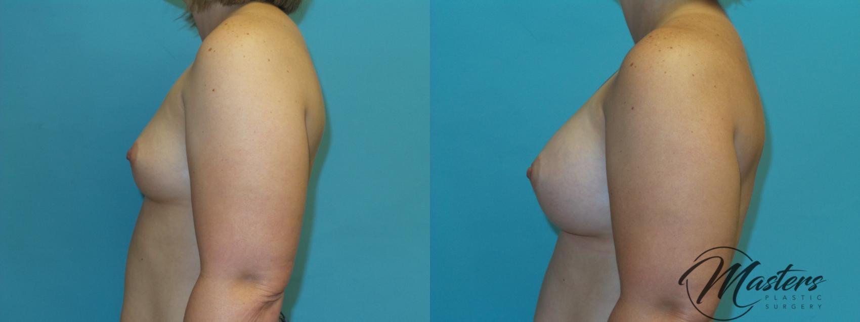 Before & After Breast Augmentation Case 4 Left Side View in Oklahoma City, Tulsa, Norman, OK