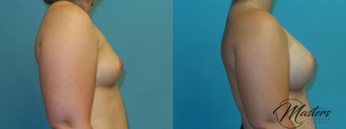 Before & After Breast Augmentation Case 4 Right Side View in Oklahoma City, Tulsa, Norman, OK