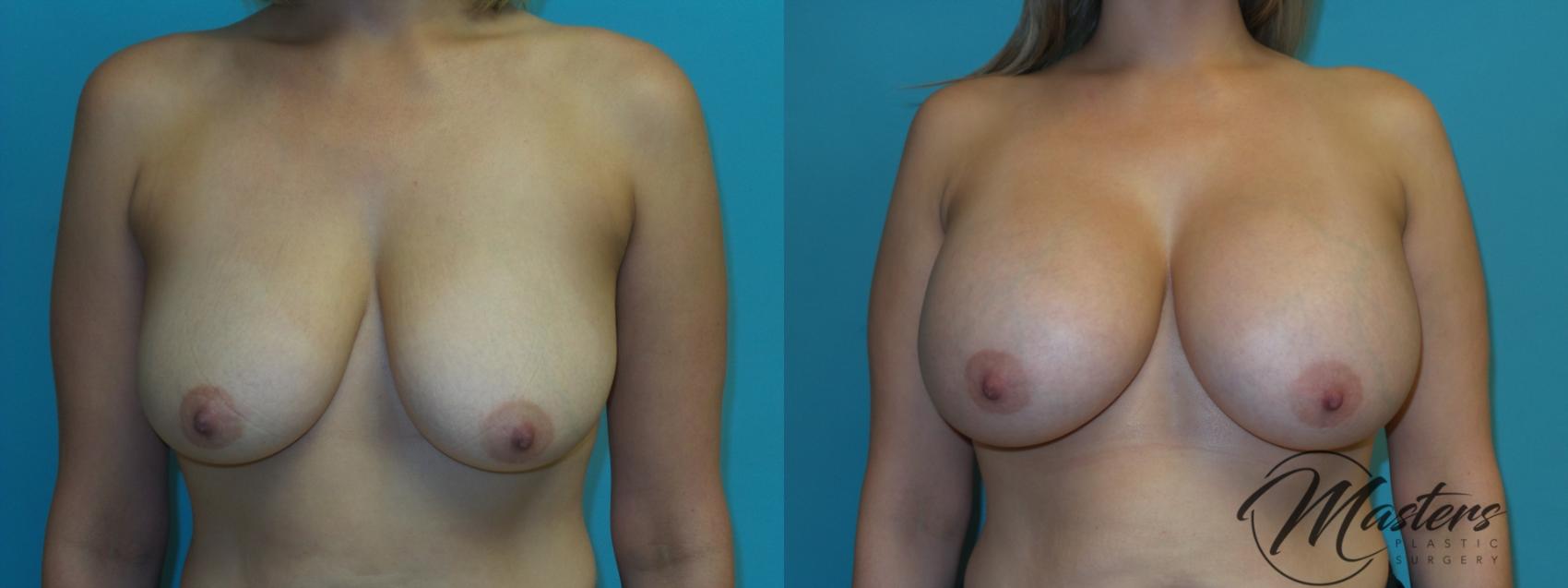 Before & After Breast Augmentation Case 6 Front View in Oklahoma City, Tulsa, Norman, OK