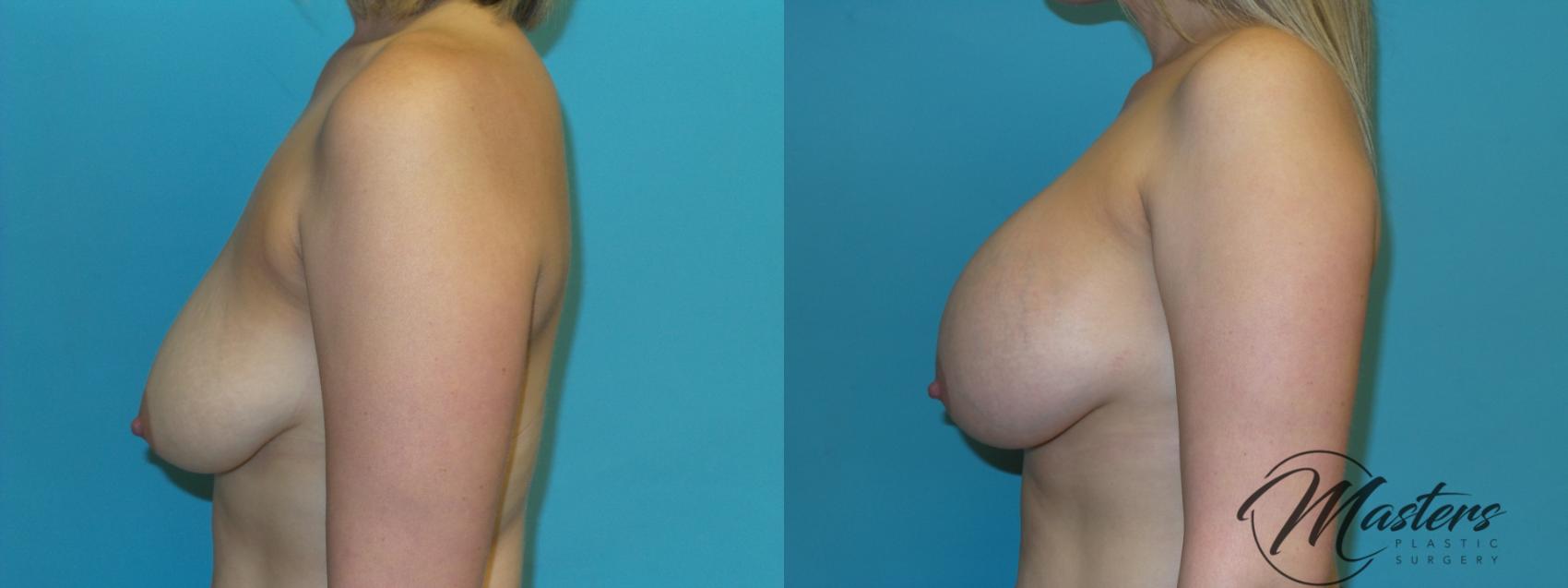 Before & After Breast Augmentation Case 6 Left Side View in Oklahoma City, Tulsa, Norman, OK