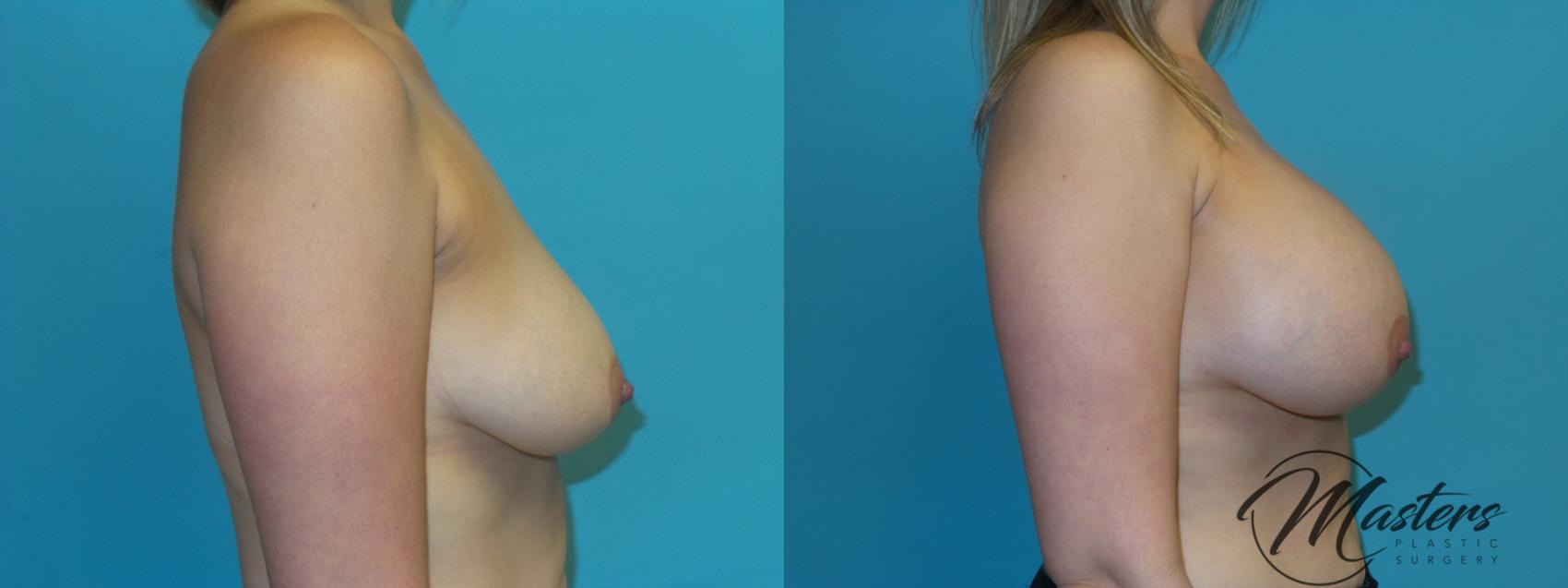 Before & After Breast Augmentation Case 6 Right Side View in Oklahoma City, Tulsa, Norman, OK