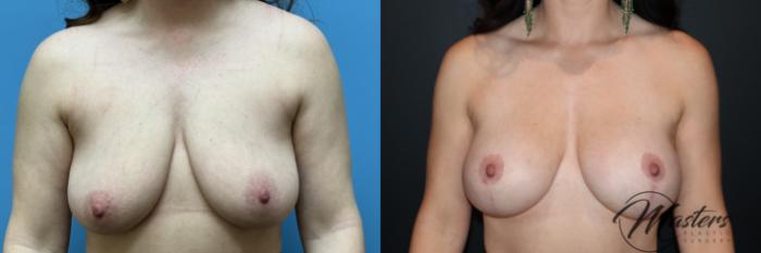 Breast Augmentation with Mastopexy Dr.Oscar Masters Masters Plastic Surgery 