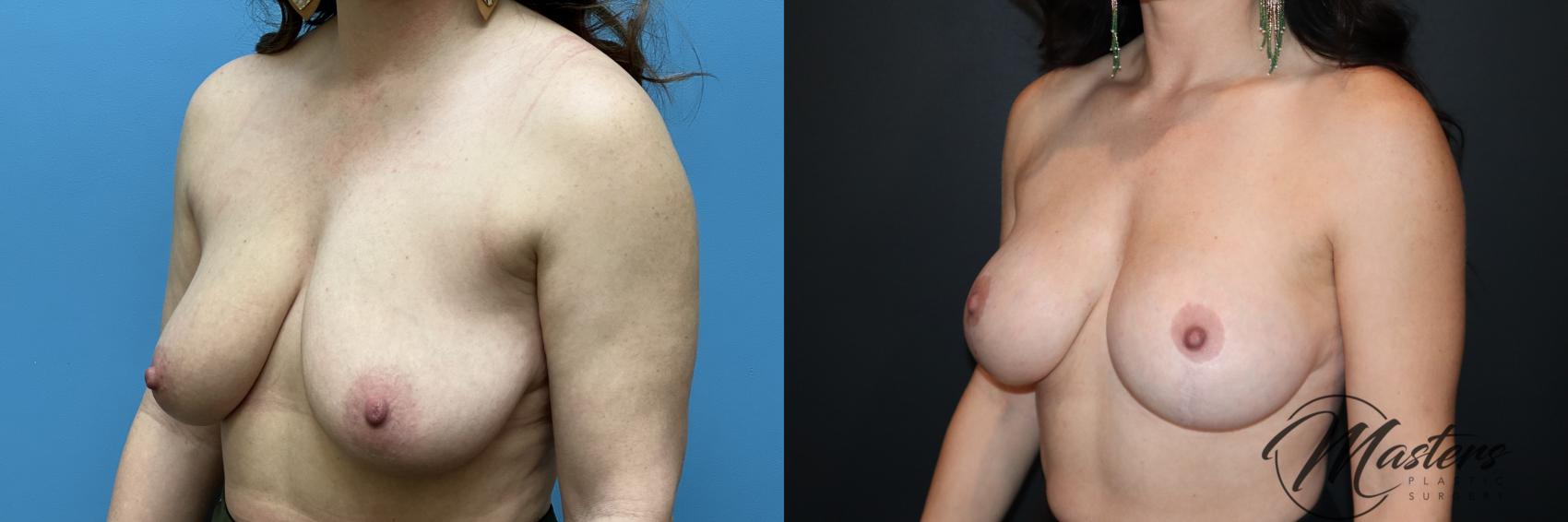 Breast Augmentation With Mastopexy 