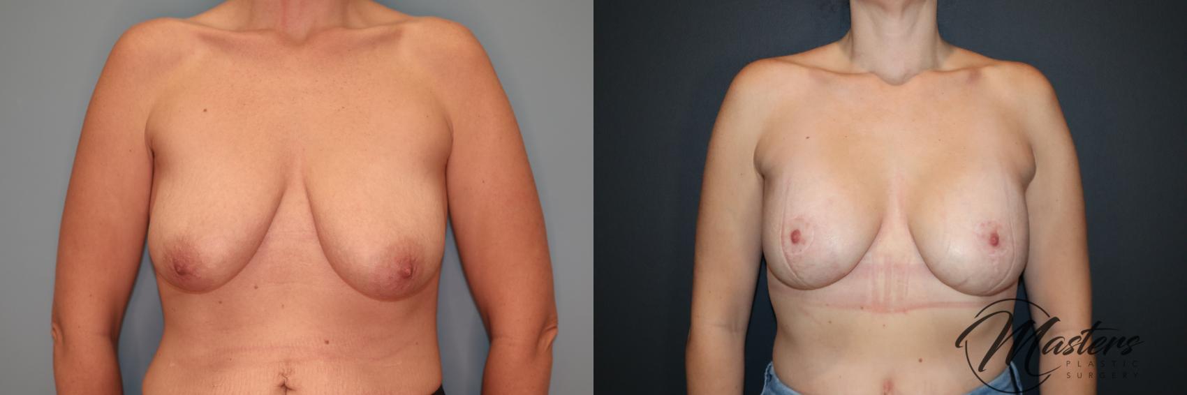 Breast Augmentation With Mastopexy 