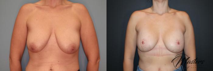 Breast Augmentation With Mastopexy 