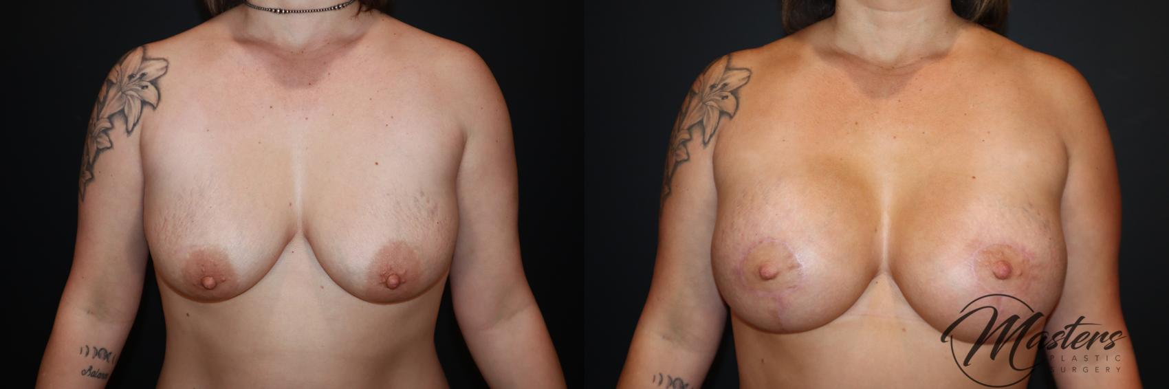 Breast Augmentation With Mastopexy 